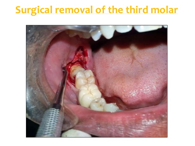 Surgical Extractions and Impactions 1